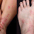 How to Tell If You Have Eczema or Psoriasis (And How to Get Rid of Both)